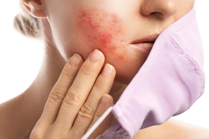 What is Hormonal Acne and How To Get Rid of It
