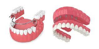 Zirconia Implant Bridge vs. Dentures: Which Should You Choose